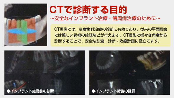 CTの三次元画像により、従来よりさらに正確な診査・診断が可能で、安全な治療を行うことができます。